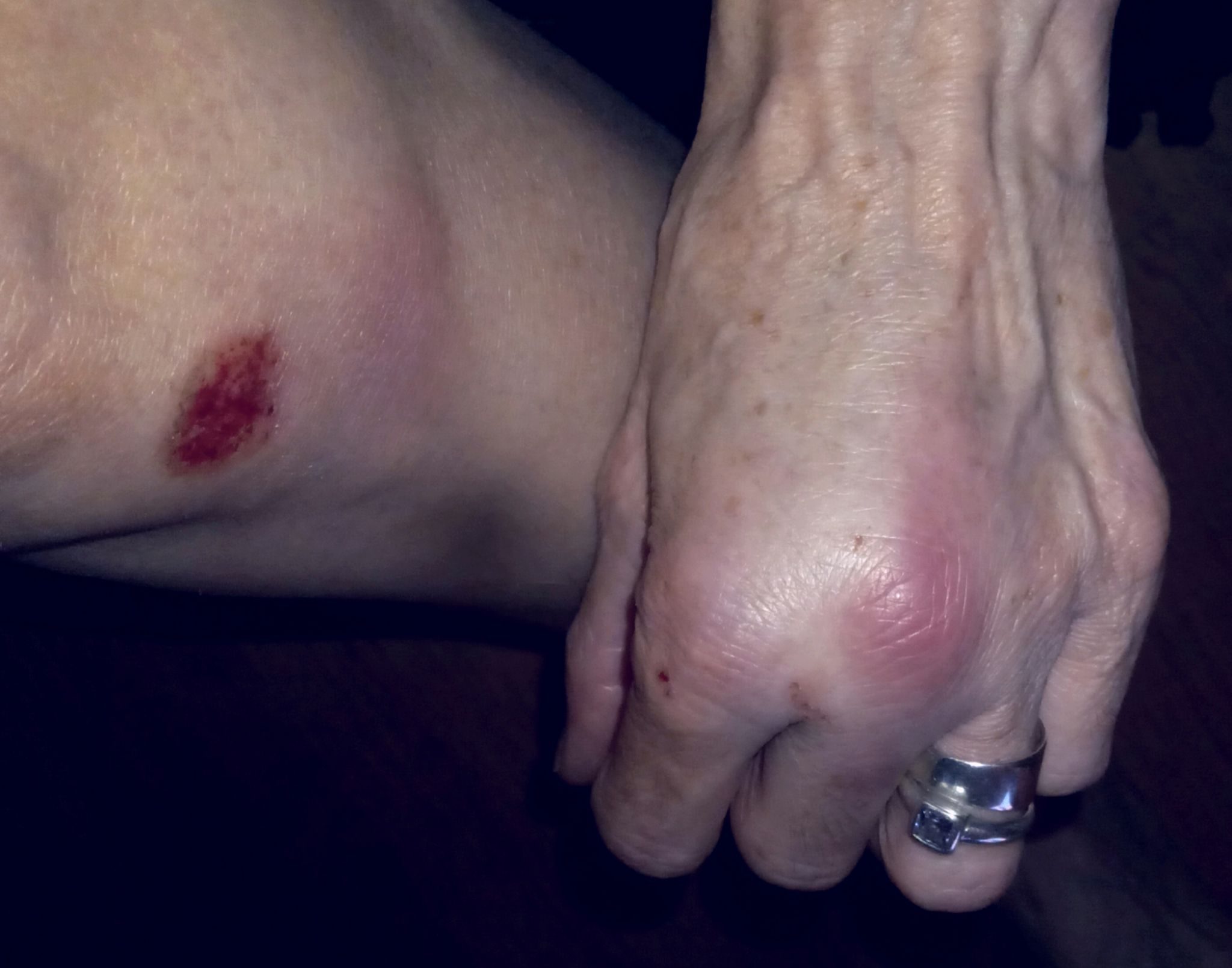 Photo of cuts and bruises on hand and knee