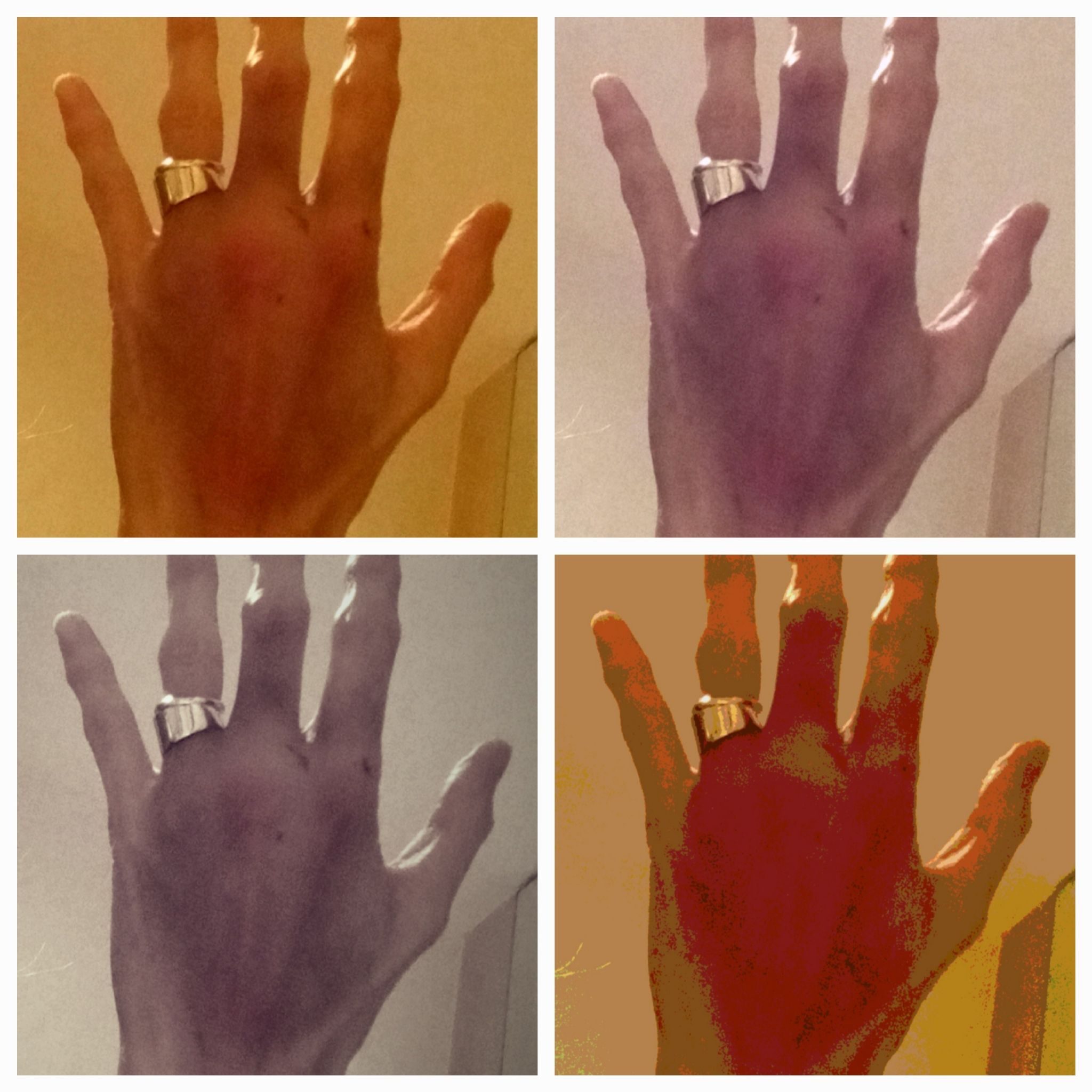 4 photo collage, showing bruising on left hand