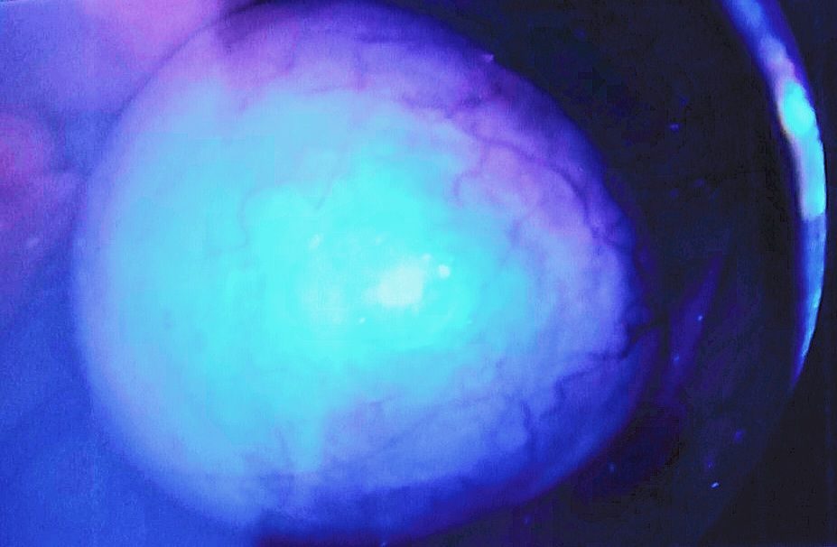 Distorted photo of my ovarian cyst, now removed