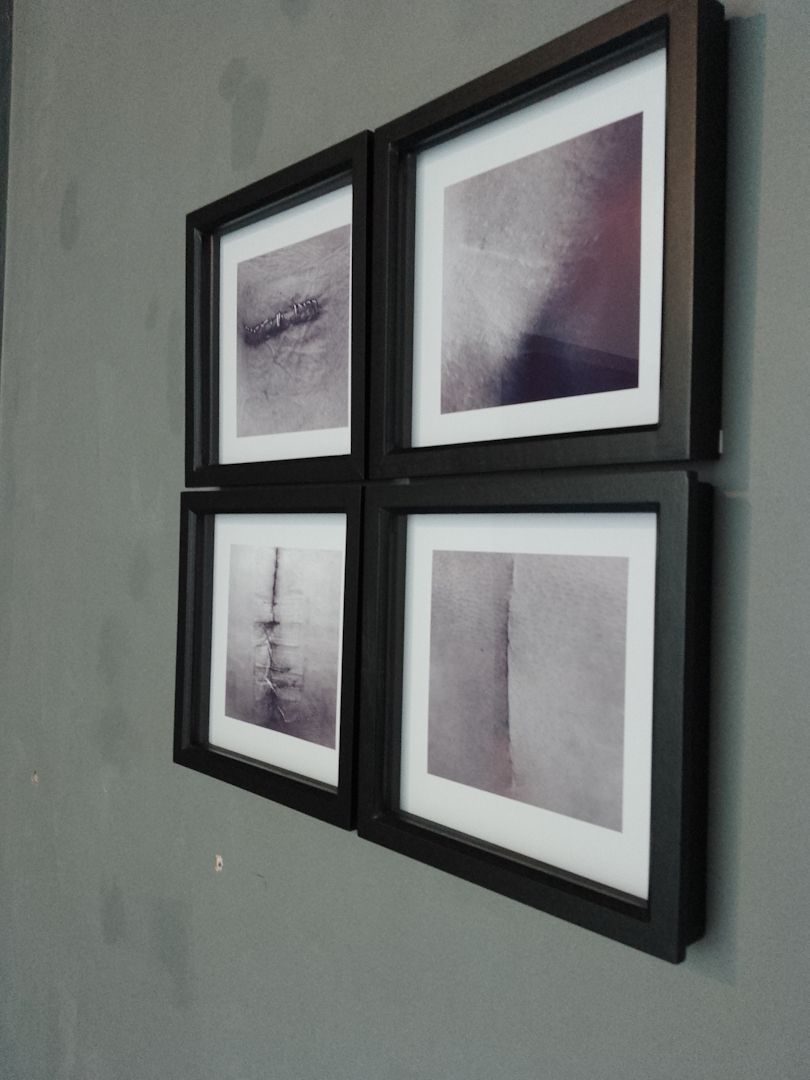 Four black and white framed photographs arranged in a 2 x 2 grid. The photographs feature recent and healed surgical incisions.